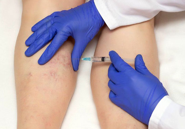 En què consisteix l’esclerosi vascular
