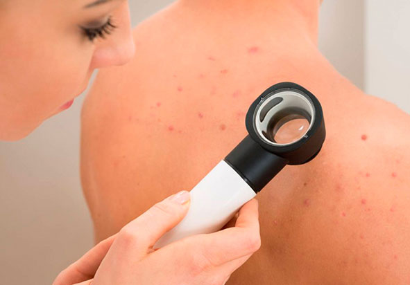 Com abordar la psoriasi en nens de forma precoç i efectiva
